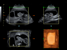 Ecografía trillizos en la semana 13 de gestación