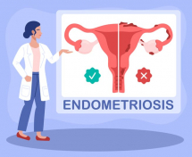 Endometriosis y fertilidad